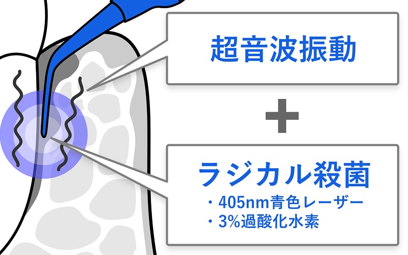 歯周治療の説明図。ブルーラジカル治療では超音波振動による清掃と光と薬剤による化学的な殺菌作用を組み合わせたアプローチで、器具による清掃では届きにくかった場所にもアプローチできることを示す。