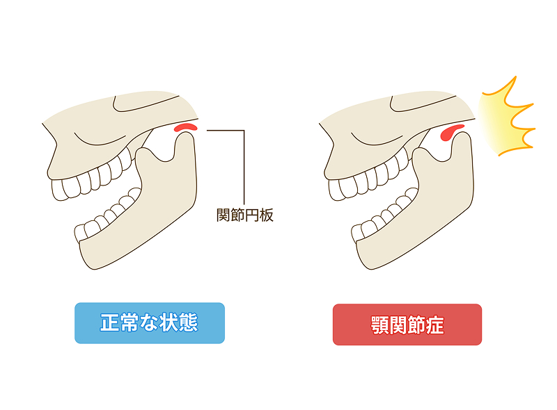 顎関節の状態を比較したイラスト。左は関節円板が正しい位置にある「正常な状態」、右は関節円板がずれて痛みが出ている「顎関節症」を示している。