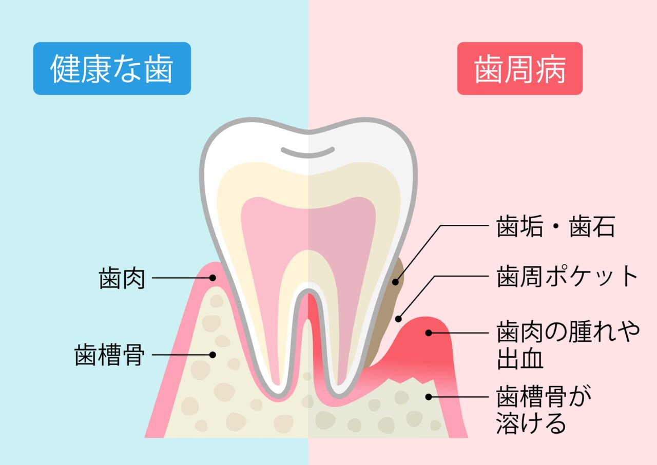 歯周病の進行イメージ
